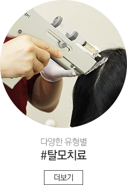 탈모치료